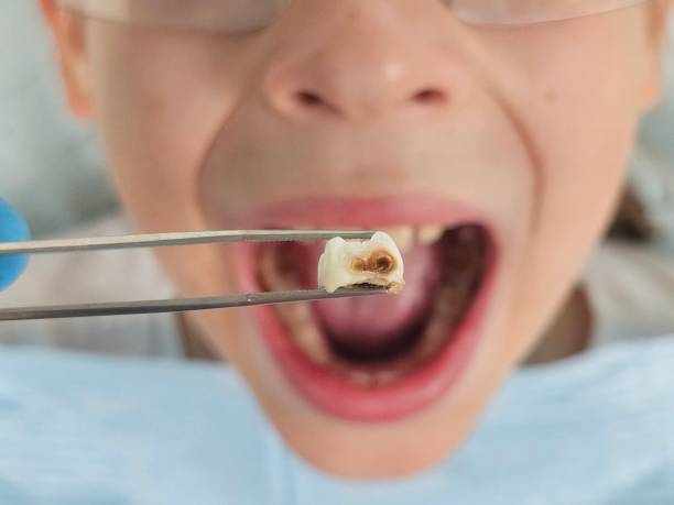 Best Knocked-Out Tooth Emergency  in Mount Carmel, IL
